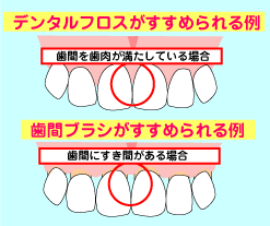 歯間ブラシとデンタルフロスの使い分け方
